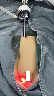 Single-port laparoscopy-assisted trans-scrotal hernia sac ligation for pediatric male inguinal hernia